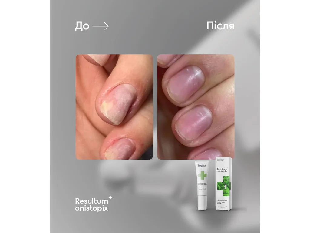Resultum Onistopix Oil – Aceite regenerador para uñas y piel